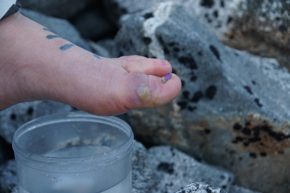 Blisters are easier to prevent than treat